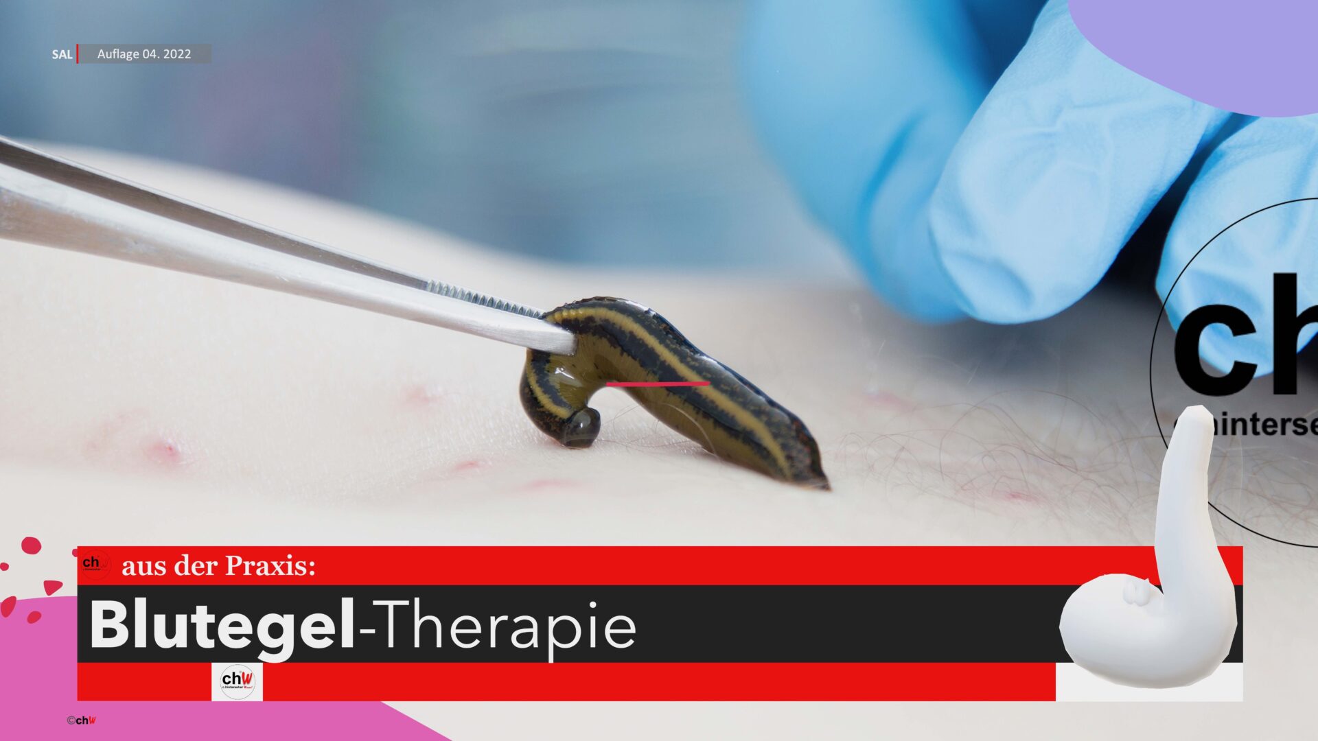 chW aus der Praxis BlutegelTherapie Kapitel II C. Hinterseher Wissen