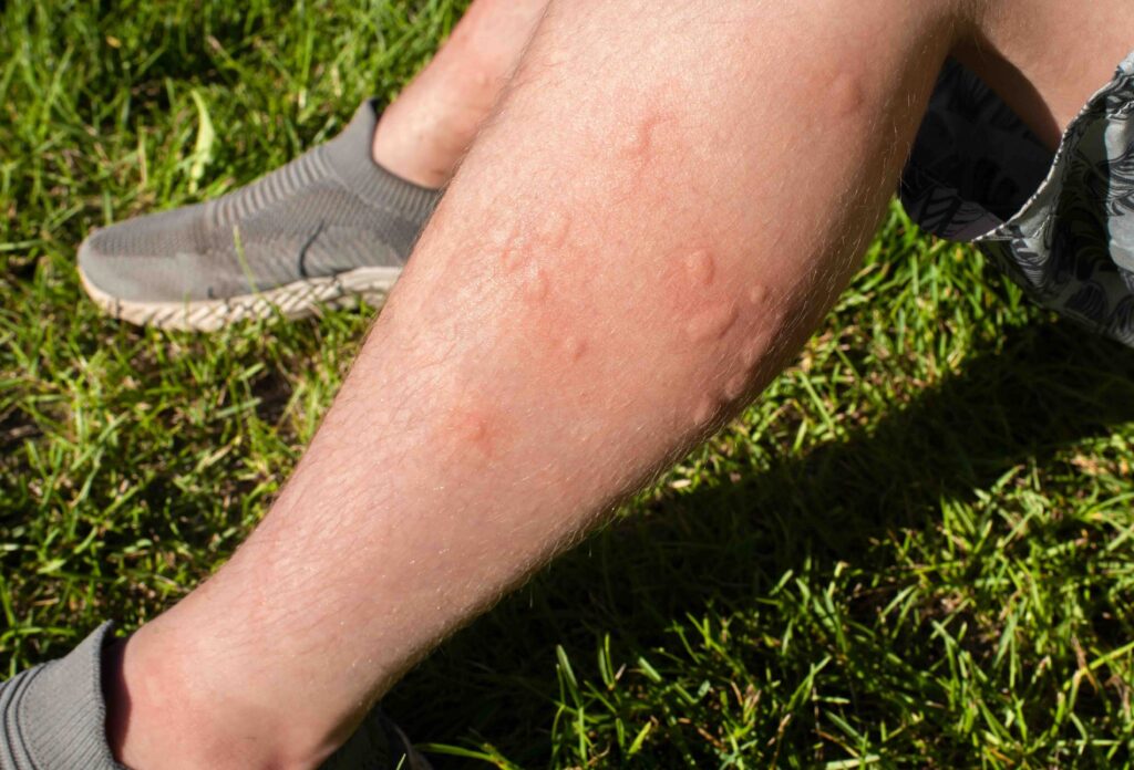 traces of multiple mosquito bites on the child’s legs