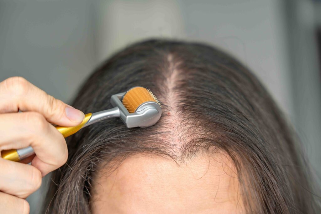 Close up view of young woman using microneedle derma roller on head for stimulating new hair growth in home. Treatment for the healthy scalp. High quality photo