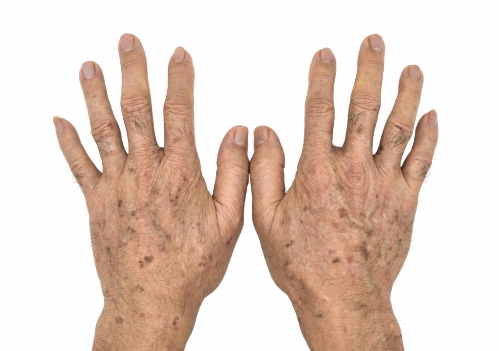 Age spots on hands of Asian elder man. They are brown, gray, or black spots and also called liver spots, senile lentigo, solar lentigines, or sun spots.