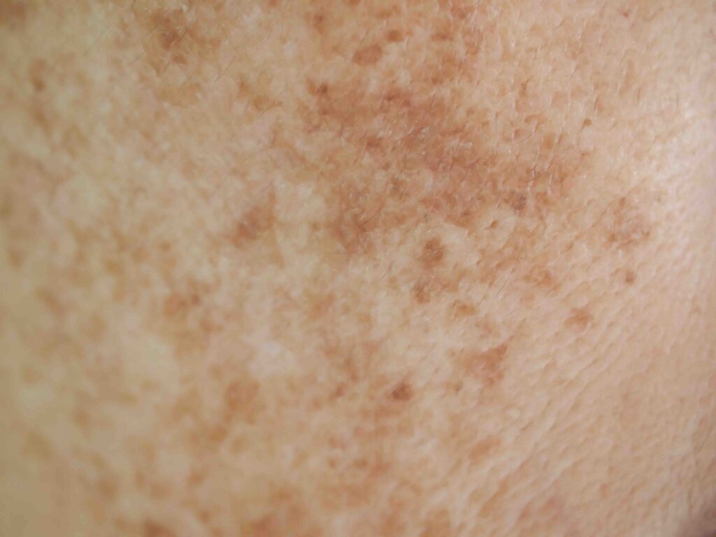 Problem skincare and health concept. Closeup wrinkles, melasma, Dark spots, freckles, dry skin ,pigment on asian woman face texture background.