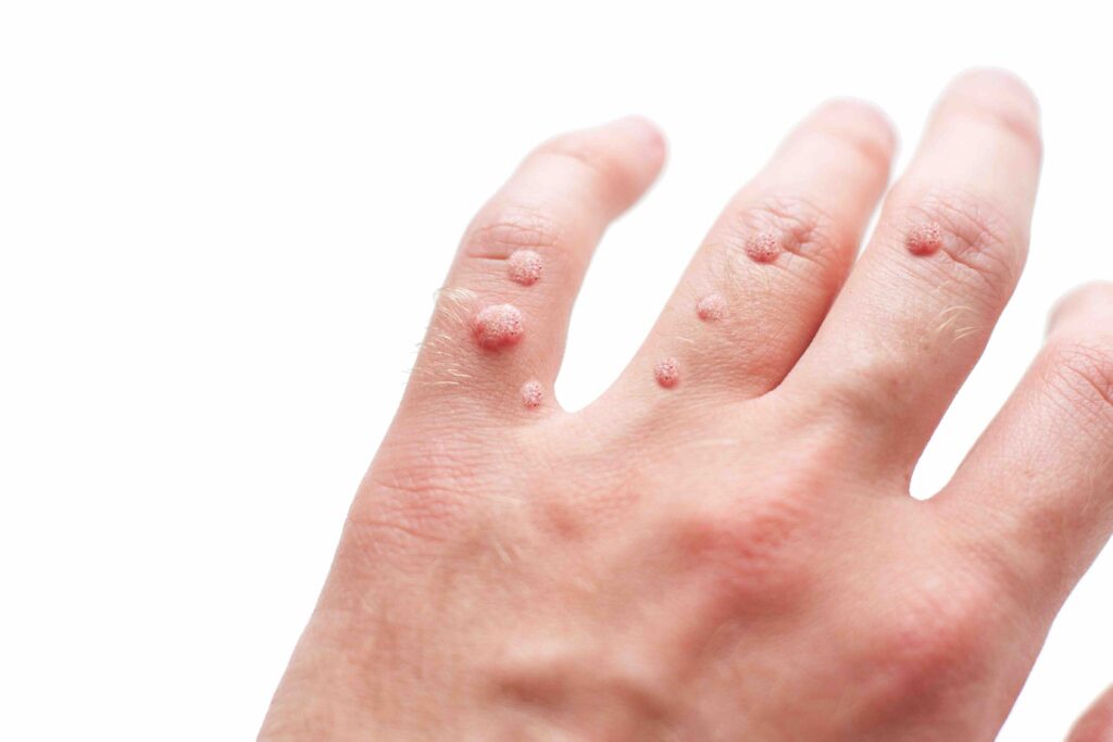 
A lots of Viral warts on hand