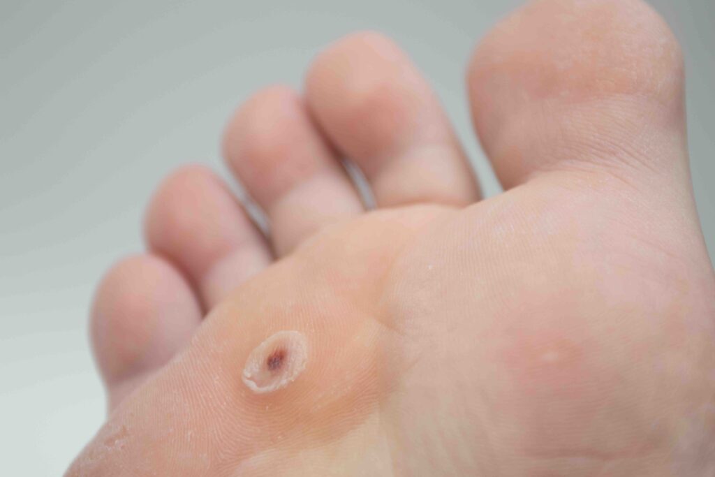 Toe wart. Foot with wart on a toe. Wart verrucas plantar.