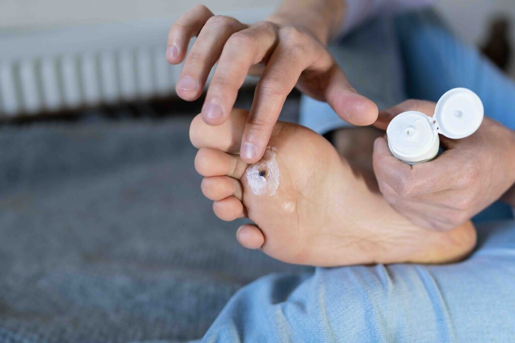 Man applies protective cream around wart plantar on his foot before cauterizing it with celandine extract. Alternative home treatment for warts. Verrucas papilloma callus virus or HPV.