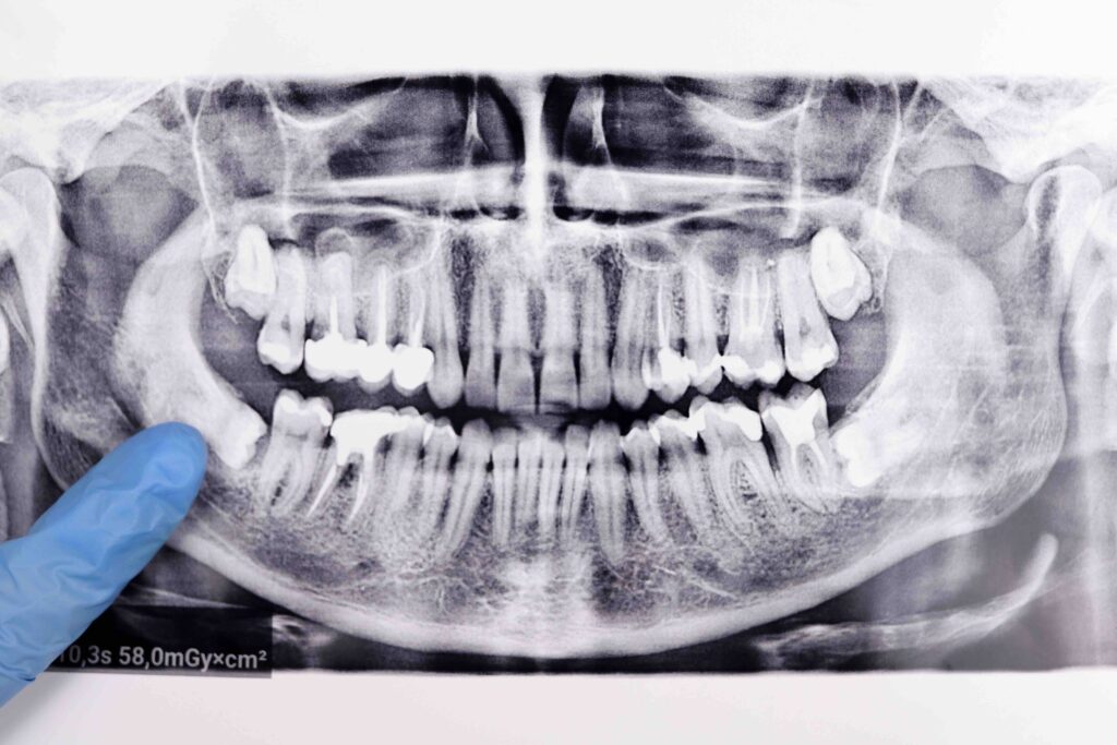 Dentist points finger at wisdom tooth at Panoramic dental tooth X-ray examination