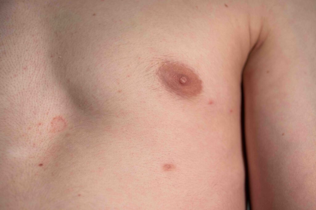 Photo of caucasian male body with a supernumerary nipple (Third nipple)