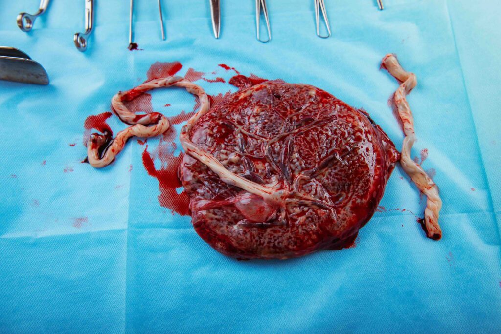 Placenta and Umbilical Cord of newly born baby